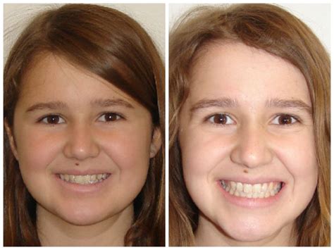 Pin by Dr. Paula Baby and Dr. Jaime R on Before and After Braces ...