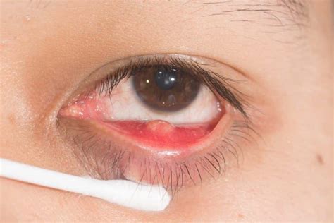Internal stye: what is it, causes and treatment - Área oftalmológica