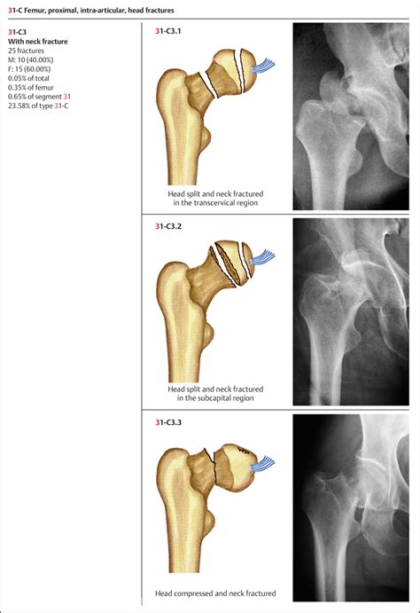 Fractures of the Femur | Musculoskeletal Key