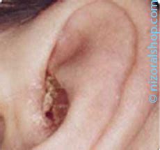 Ear Psoriasis