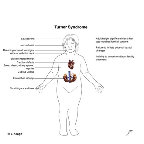 Turner Syndrome - Reproductive - Medbullets Step 1