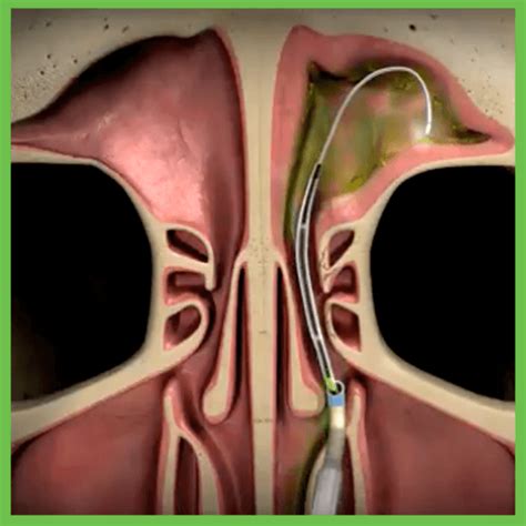 Is Balloon Sinuplasty a Good Option? - Houston Advanced Sinus