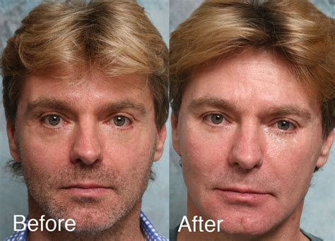 Fixing Botched Lower Eyelids Surgery (2022)