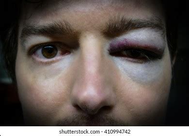 Eye Injury Man After Accident Fight Stock Photo 410994742 | Shutterstock