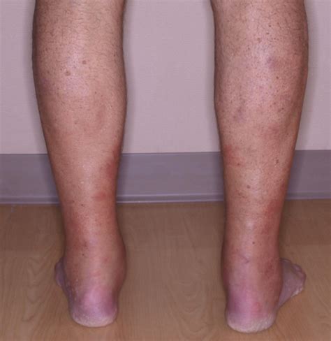 Coccidioidomycosis Rash