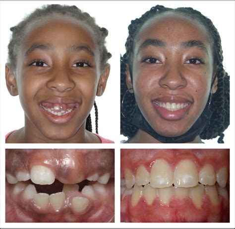 Invisalign Before And After Severe Crowding