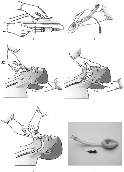 The laryngeal mask airway: A comprehensive review for the Emergency Physician1 - Journal of ...