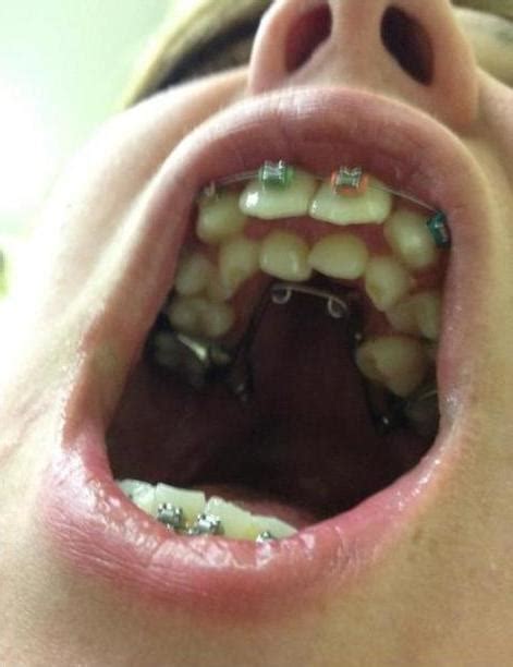 Multiple Hyperdontia