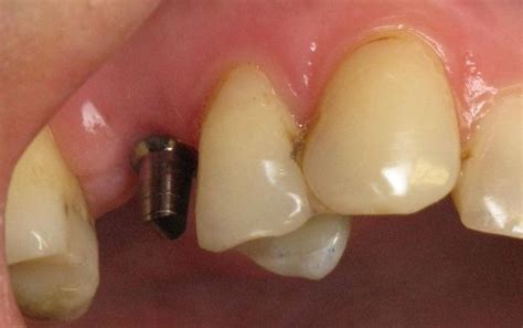 Mini Dental Implants Can Replace a Broken Upper Tooth with a Fixed Porcelain Crown - Mini Dental ...