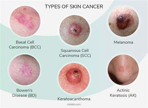 Skin Cancer Types Squamous Cell Carcinoma