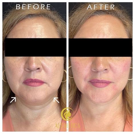 Cheek Fillers – Aesthetica Medspa