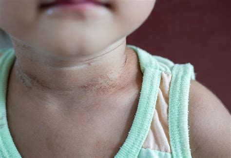 Rashes On Baby's Neck - Reasons & Treatment