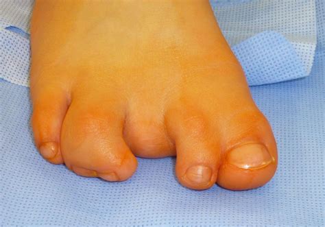 Toe Syndactyly | Toes, Beautiful toes, Amputee