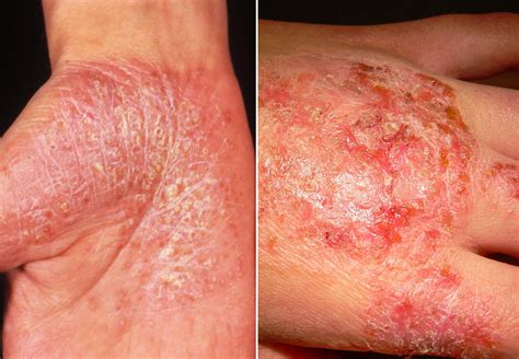 What Is Eczema Dermatitis Is The Inflammation Of Skin | My XXX Hot Girl