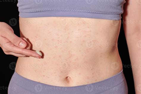 Red allergic rash on belly skin, atopic dermatitis, eczema, inflammation. Woman applying ...