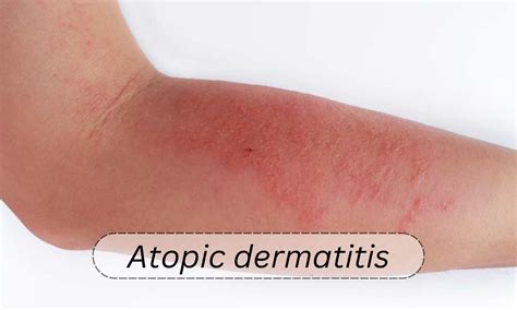 Management of atopic dermatitis with topical therapies in adults: Updated guideline by AAD