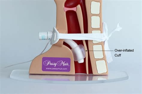 Troubleshooting the Tracheostomy Tube and Speaking Valve for Improved ...