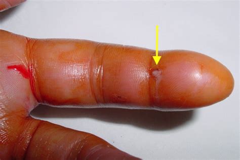 INFECTION, FLEXOR TENDON SHEATH | Hand Surgery Resource