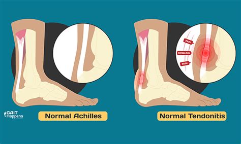 Know the Symptoms of Achilles Tendonitis / Tendinopathy | Gait Happens