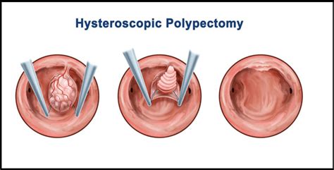 Hysteroscopic polypectomy | Angels Fertility