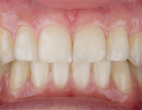 Metal Teeth Braces Treatment in Dubai | Veneto Clinic