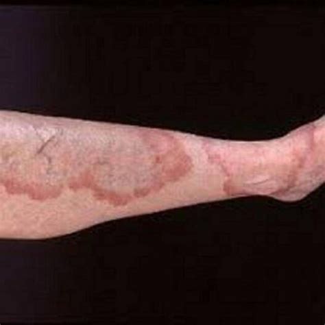 Granuloma Annulare: 5 Symptoms, Causes, And Treatment » 2022