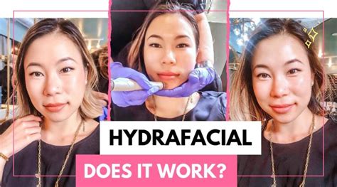 HYDRAFACIAL Overview | Earlier Than And After - OLCBD.net