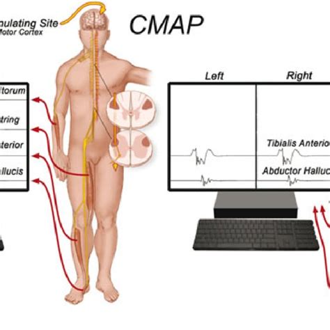 1 Illustration depicting placement of electrodes for monitoring of... | Download Scientific Diagram