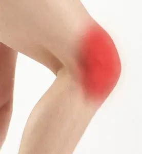 Anterior Knee Pain Treatment New Bedford, Swansea | Patella Fracture ...