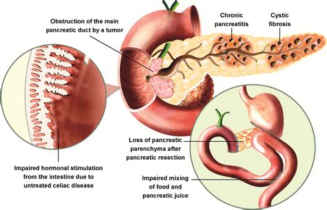 200以上 exocrine pancreatic insufficiency symptoms mayo clinic 642909