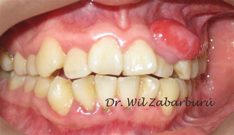 CLINICA DENTAL ASISTENCIAL: GRANULOMA PIÓGENO