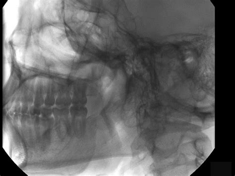 Juvenile Recurrent Parotitis Sialogram | Iowa Head and Neck Protocols