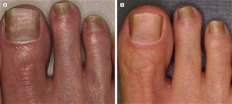 Successful Treatment of Toenail Onychomycosis With Photodynamic Therapy | Dermatology | JAMA ...