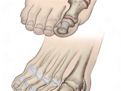 psoriatic arthritis feet Archives - DeNiel Foot and Ankle Center - Ejodamen B Shobowale, DPM