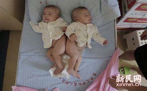 Twins, Joined at the Butt, Will be Separated Tomorrow Thanks to 3D ...