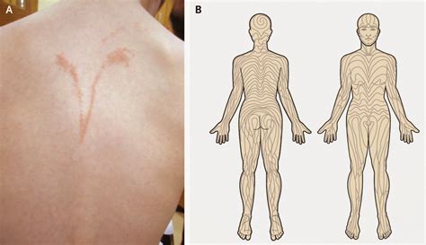 Dermapixel: Liquen estriado: la inflamación de las líneas de Blaschko