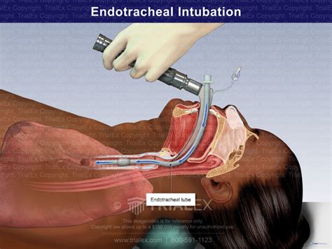 Endotracheal Intubation