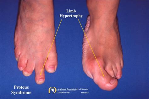 Proteus syndrome - cupultra