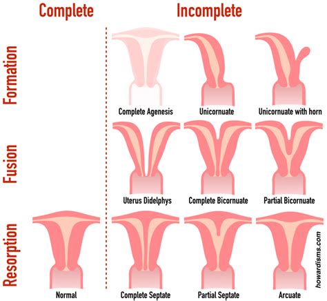 Four Tips for Correctly Diagnosing Uterine Anomalies