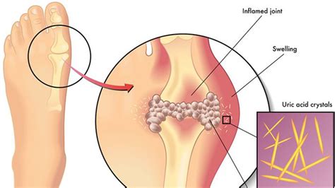 Gout: Causes, symptoms, diagnosis - FamousPHD