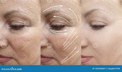 Elderly Woman Face Wrinkles Arrow Mature Effect Cosmetology Tightening ...