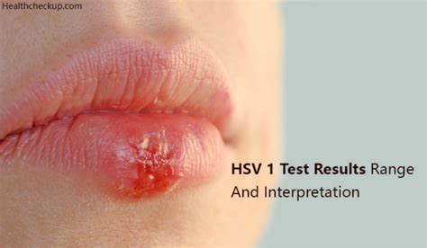 HSV 1 Test Results Range And Interpretation - Health CheckUp