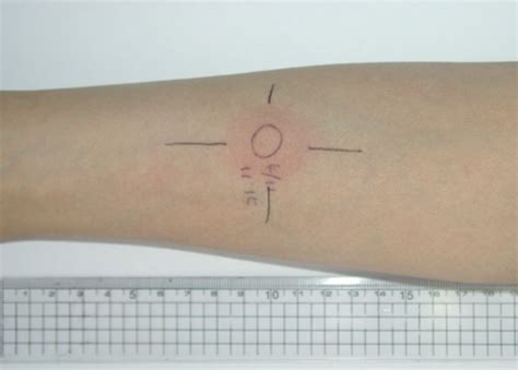 Tuberculin test was performed after the patient was stabilized with ...