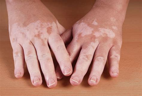 Leprosy: 10 Symptoms of Leprosy