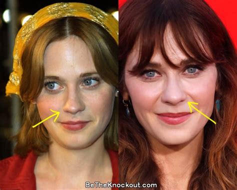 Zooey Deschanel Plastic Surgery Comparison Photos