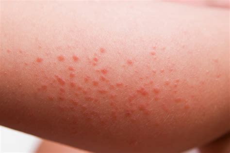 Celiac Disease Rash (Dermatitis Herpetiformis) Explained - Good For You ...