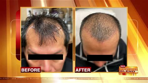 Hair Restoration Options for Men and Women