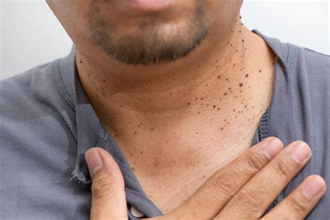An Integrative Medicine Approach to Skin Tags