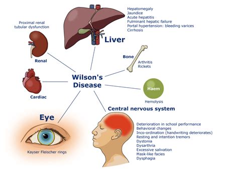 Boala Wilson - cauze, simptome, diagnostic si tratament ...