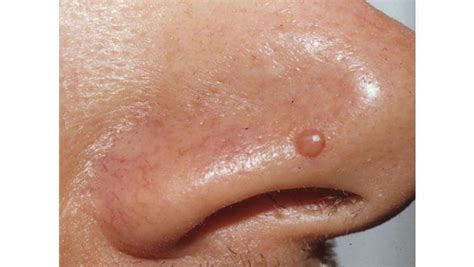 Fibrous Papule of the nose is a common skin condition. Learn about causes, symptoms ...